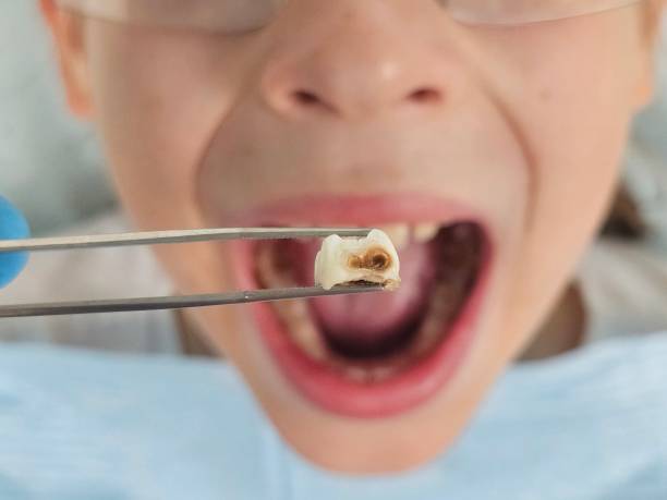 Best Dentist for Tooth Abscess  in Hillsboro, KS